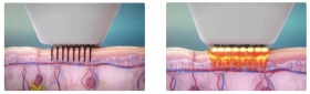 What's the Difference Between Insulated RF Needles And Non-Insulated RF Microneedles?