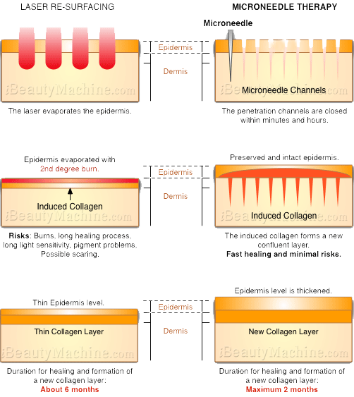 Microneedling Chart