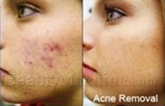 LED blue light acne removal before and after