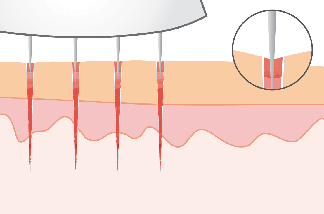 scalp micropigmentation