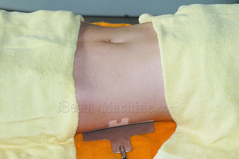 Monopolar RF Skin tightening machine