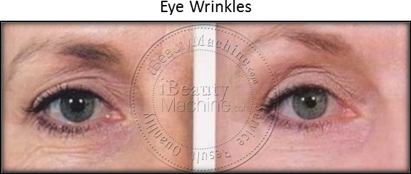 Eye Wrinkles