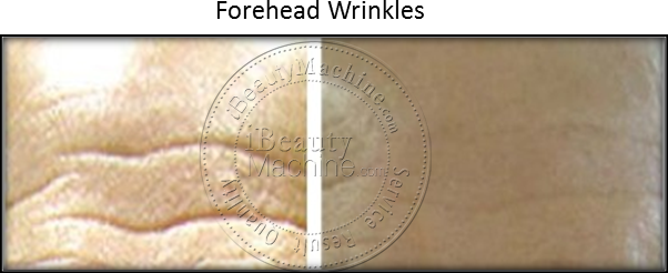 Forehead Wrinkles