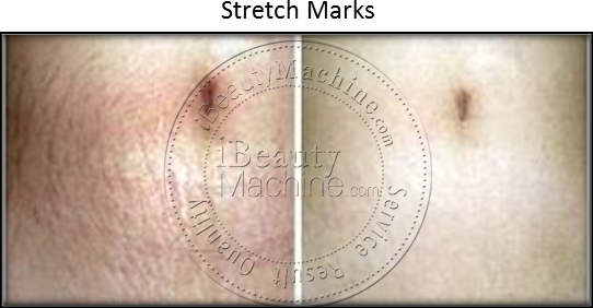 Stretch Marks