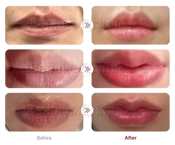 Priere Tulip before and after