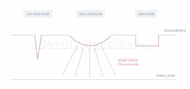 Rejuran S acne-scars removal procedure