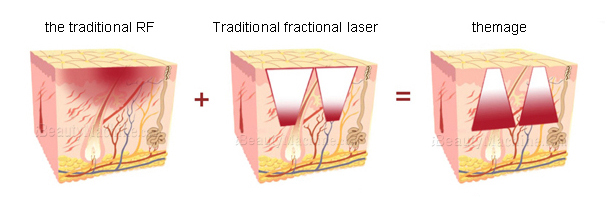 RF Fractional Machine working principle