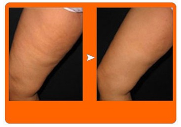 RF appearance of cellulite improvement before and after
