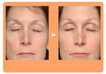 factional rf facial wrinkle removal before and after