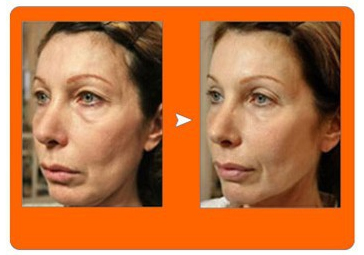 matrix RF skin tightening before and after