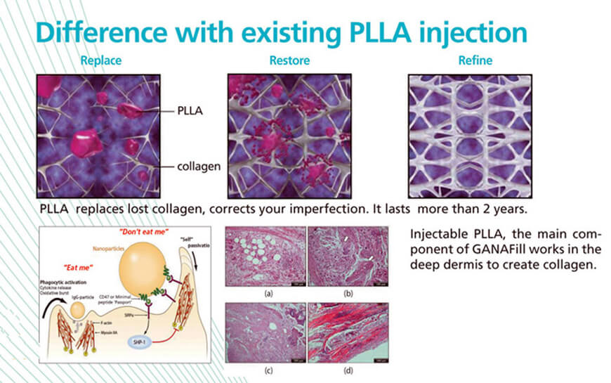 PLLA face filler