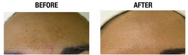 Personal Microderm before and after