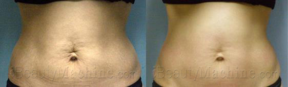 RF skin tightening BA photos