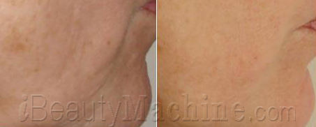 RF skin tightening BA photos
