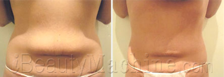 cavitation fat removal results