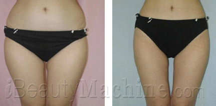 cavitation fat removal results