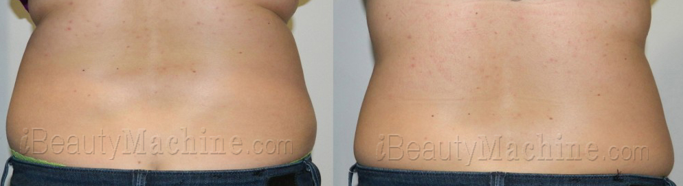 lipo suction fat removal BA