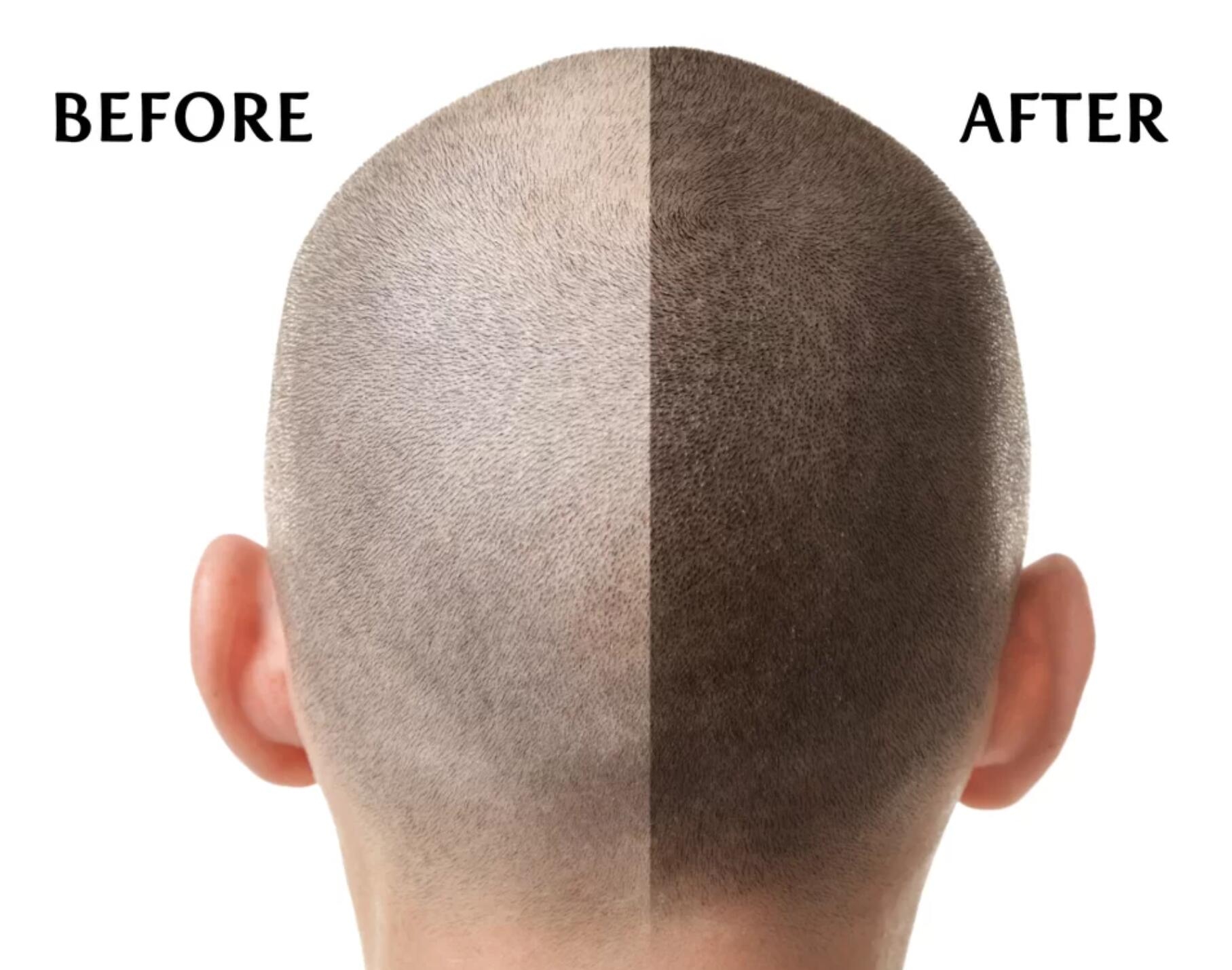 scalp micropigmentation