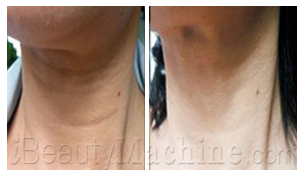 Neck wrinkles removal BA photos