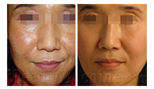 Pigmentation removal BA photos