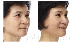 cheek wrinkles removal BA photos