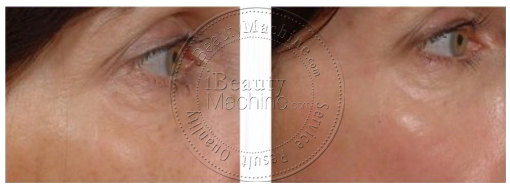 eye care before and after photos