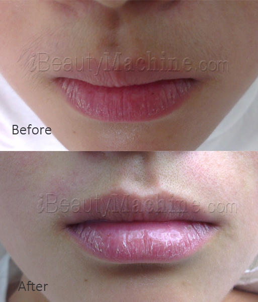 upper lip hair removal