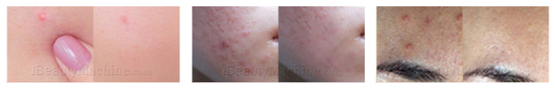 before and after acne removal