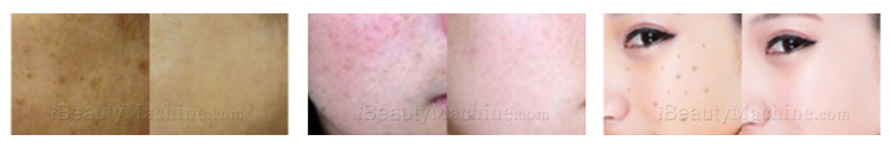 before and after pigmentation removal