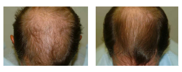 treatment for hair loss