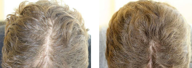 Best Hair Loss treatment comb before and after