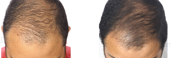 hotselling hair loss solutions before and after