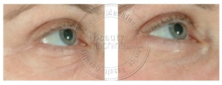 Eye wrinkles removal