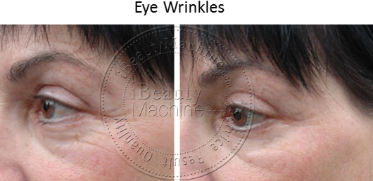 Eye Wrinkles