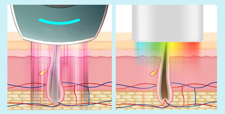home use IPL hair removal high-density energy