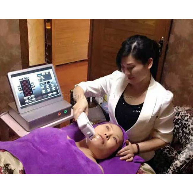 Ultralift 360P™ | Most Advanced and Super Efficient HIFU