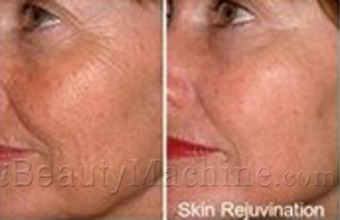 LED light skin rejuvenation before and after