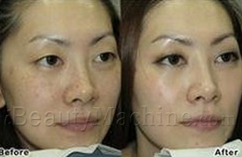 LED pigmentation removal before and after