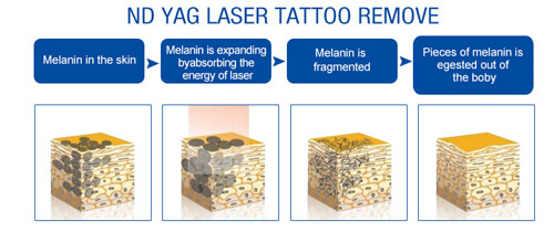 Nd Yag Laser Tattoo Removal