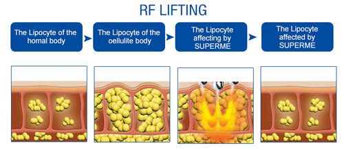 RF Skin Tighten