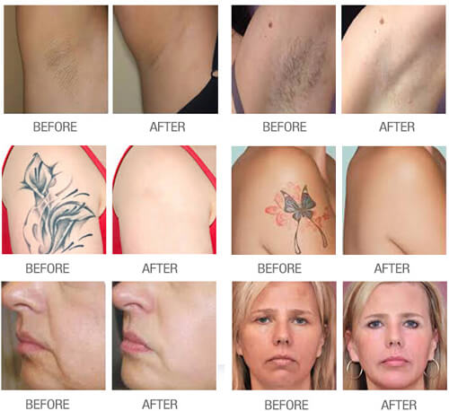 Hair removal machine reviews
