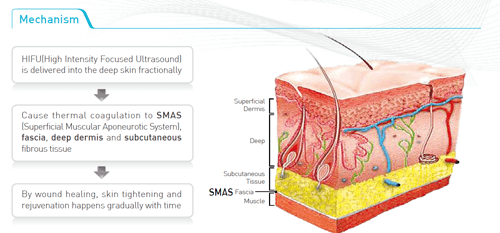 ulthera, is ultherapy work?