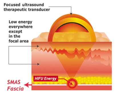 ultrasound facelift, ulthera hifu