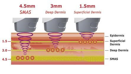 ultrasound facelift machine, ultherapy system