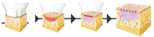 fractional rf microneedle reviews, rf fractional