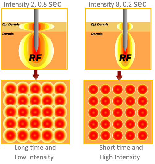 radiofrequency for skin tightening, face tightening machine