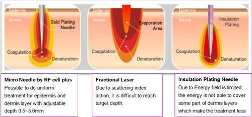 Micro Needling Depth Chart