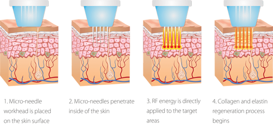 micro needling machine, Fractional micro needling rf