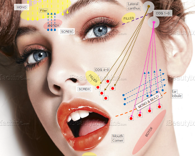 Face Lift PDO Thread Mono