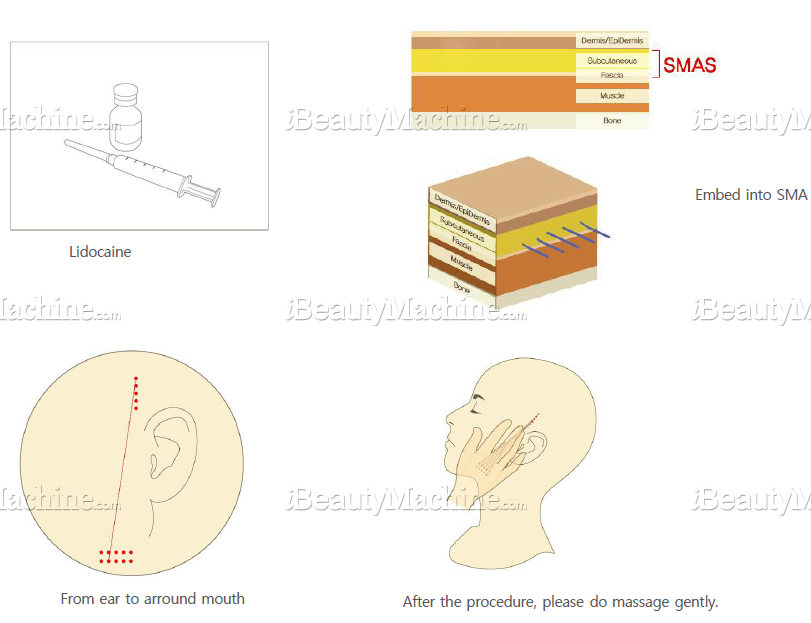 3D Barbed Thread